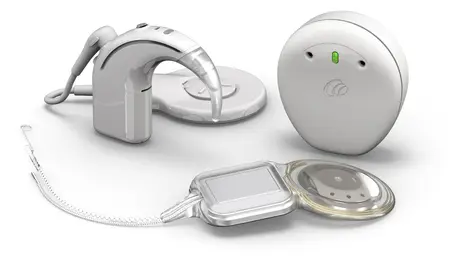 Cochlear launches Nucleus Nexa, a smart upgradeable implant